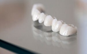 bridge dentaire en zircone