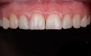 sourire avant facette en composite