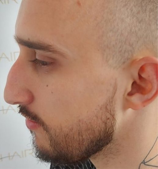 greffe de barbe après