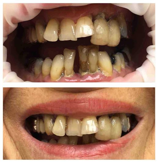 sourire avant marie madeleine mercz dental