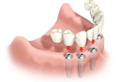 bridge complet sur implant