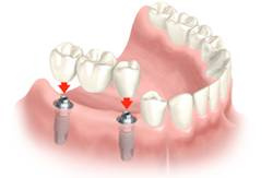 bridge sur implant
