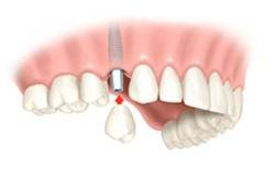 couronne sur implant