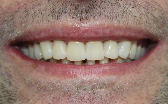 sourire hervé après