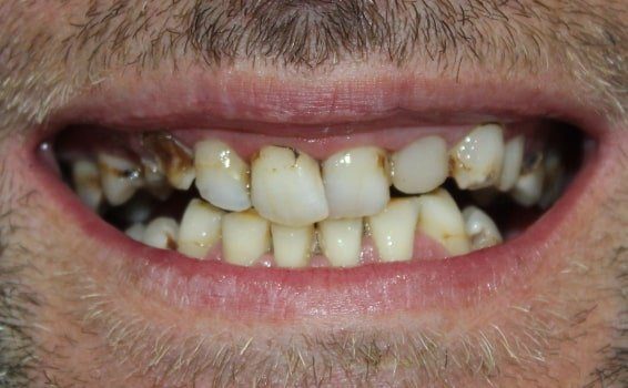 sourire hervé avant