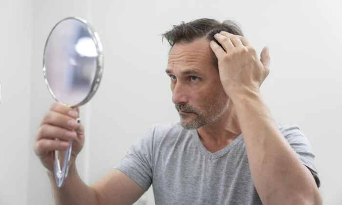 résultat greffe de cheveux 1 mois