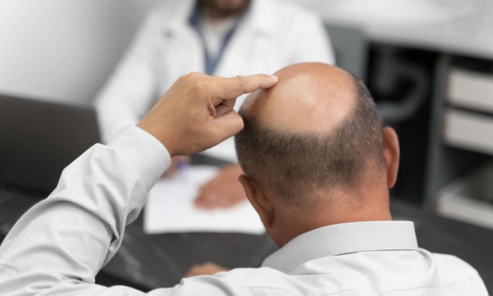 Homme en rdv pour une greffe de cheveux
