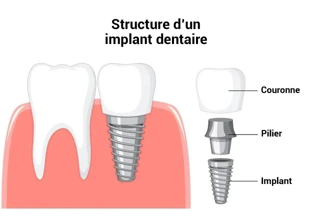 structure d'un implant dentaire