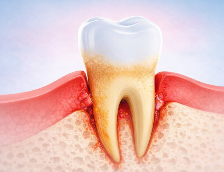 Illustration du déchaussement dentaire