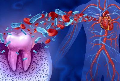 Illustration 3D montrant des bactéries circulant du site d'une dent vers le cœur à travers le système sanguin, mettant en évidence la connexion entre la santé dentaire et les maladies cardiovasculaires.