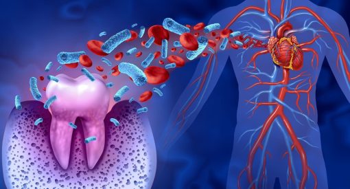 Illustration 3D montrant des bactéries circulant du site d'une dent vers le cœur à travers le système sanguin, mettant en évidence la connexion entre la santé dentaire et les maladies cardiovasculaires.