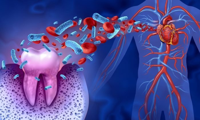 Illustration 3D montrant des bactéries circulant du site d'une dent vers le cœur à travers le système sanguin, mettant en évidence la connexion entre la santé dentaire et les maladies cardiovasculaires.