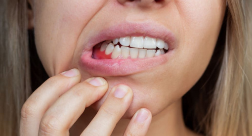 Femme montrant une douleur ou une lésion sur sa gencive inférieure, suggérant une urgence dentaire ou une inflammation des gencives.