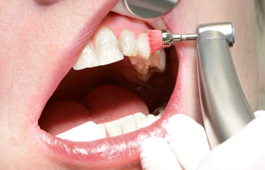 contrôle annuel professionnel des dents avec une brosse à polir par un dentiste en gants blancs.