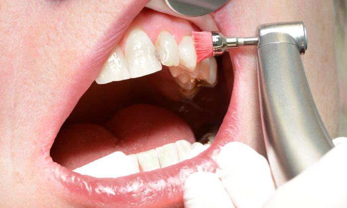 contrôle annuel professionnel des dents avec une brosse à polir par un dentiste en gants blancs.