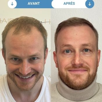 fabian avant et apres greffe de cheveux