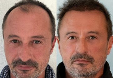 nicolas avant et apres greffe de cheveux