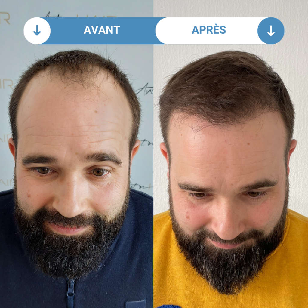 Lot De 2 Sprays Zaroza Hair - Après Greffe De Cheveux - Actifs Naturels (Aloe Vera, Biotine) - Expire 2026 - Neuf