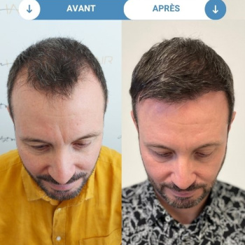 jérôme avant et apres greffe de cheveux