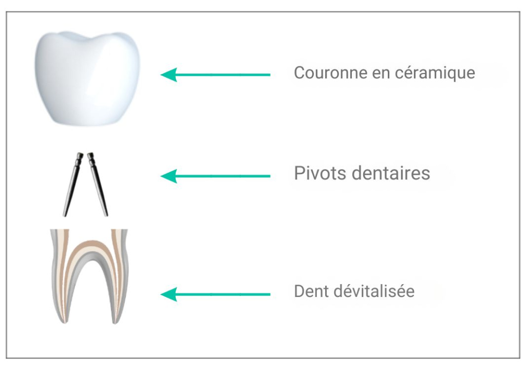 pivot dentaire représentation complète