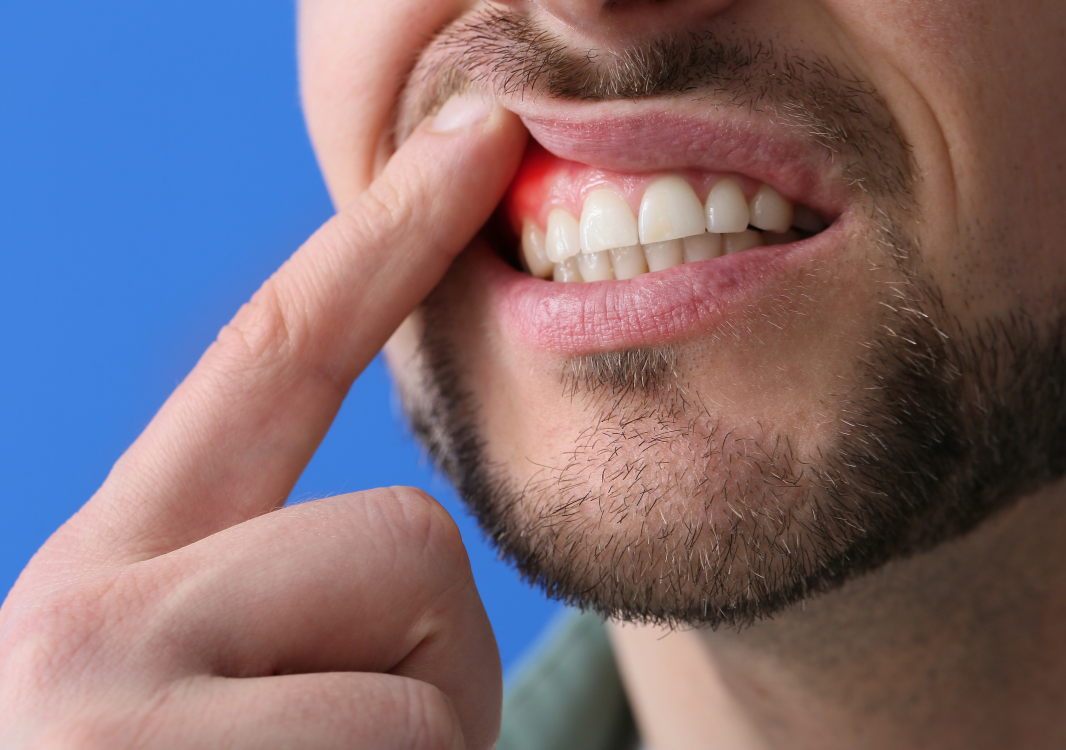 Gingivite : causes et astuces pour viter les problmes de gencive