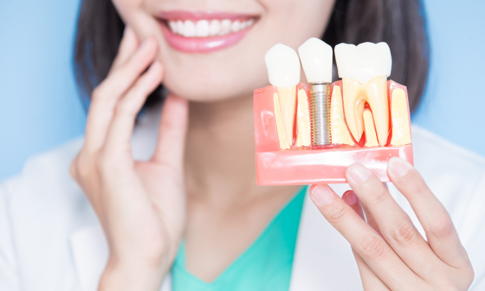 femme qui montre le remplacement des dents avec parodontite (via implant dentaire)