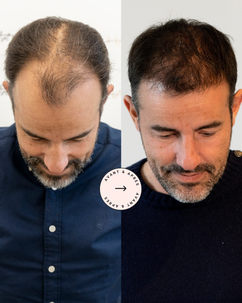 photos d'un avant/après de greffe de cheveux sur notre patient