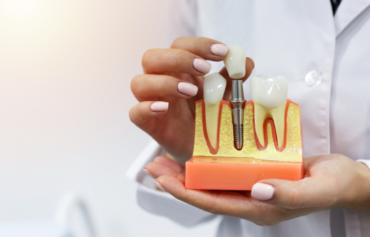 illustration d'un implant, entre deux dents saines