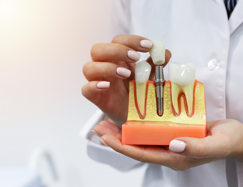 illustration d'un implant, entre deux dents saines