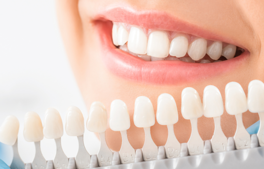 sourire d'une femme devant les teintes de dents pour couronne