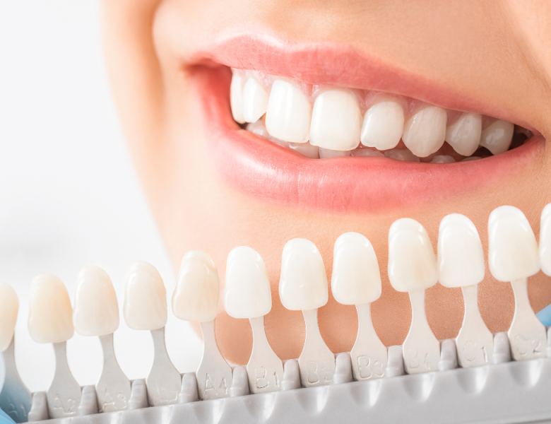 sourire d'une femme devant les teintes de dents pour couronne