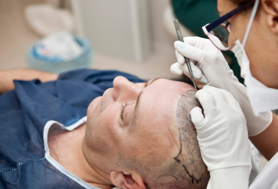 homme qui se fait une greffe de cheveux sous anesthesie locale