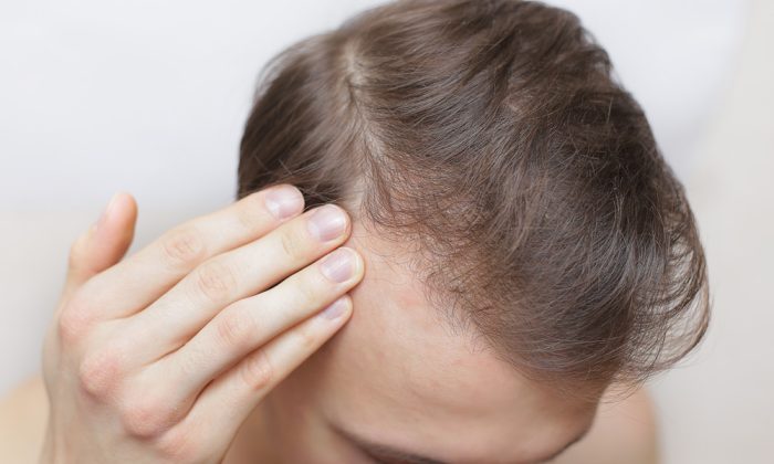 Greffe de cheveux homme sur cheveux fins