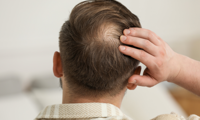 homme avec un trou au vertex