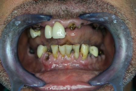 image de la dentition de notre patient avant ses prothèses