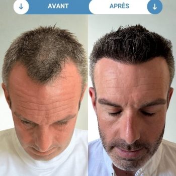 julien avant et apres greffe de cheveux