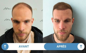 avant après maxime