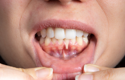 dents qui se déchaussent
