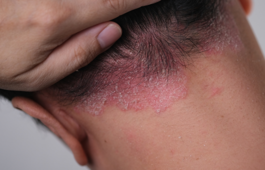 homme ayant du psoriasis sur le cuir chevelu