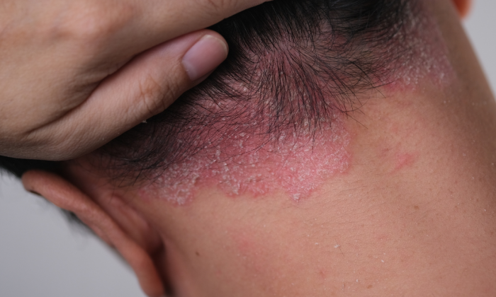 homme ayant du psoriasis sur le cuir chevelu