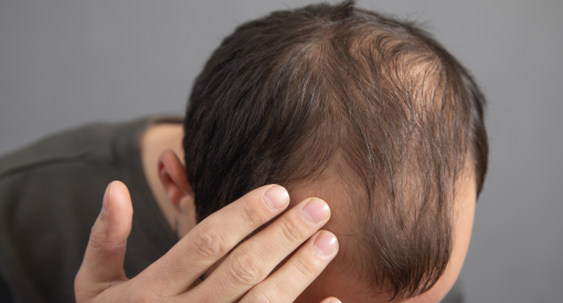 homme qui perd ses cheveux