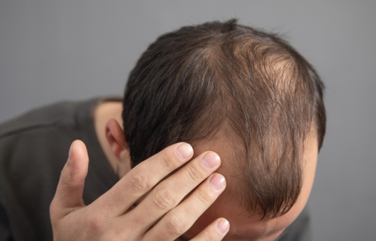 homme qui perd ses cheveux