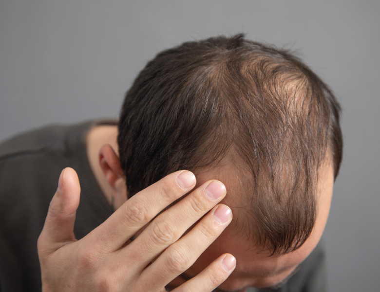 homme qui perd ses cheveux