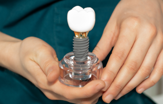 couronne sur implant dentaire