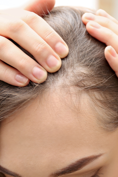 chute de cheveux femme