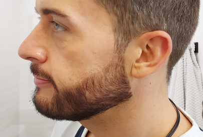 patient greffe barbe