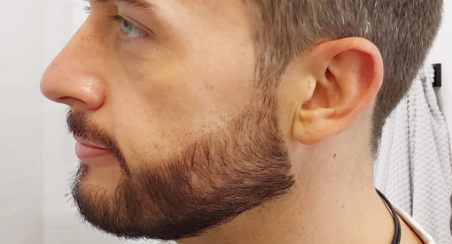 patient greffe barbe