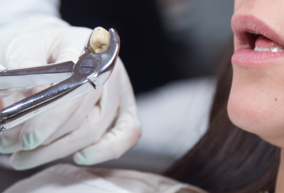 dentiste qui extrait une dent