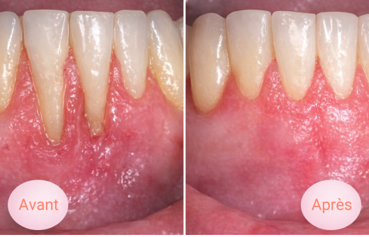 avant après traitement déchaussement des dents