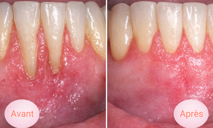 avant après traitement déchaussement des dents